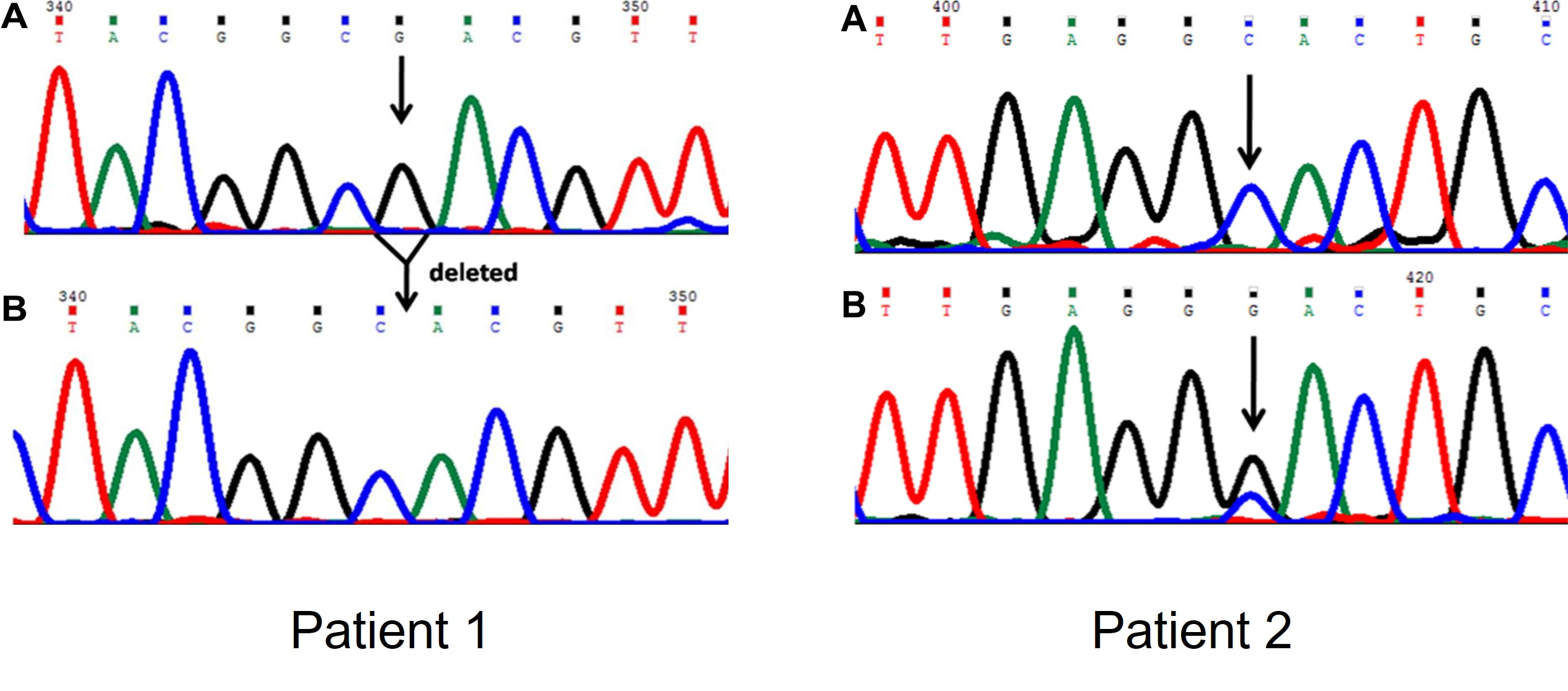 DNA chromatogram of the CFTR gene